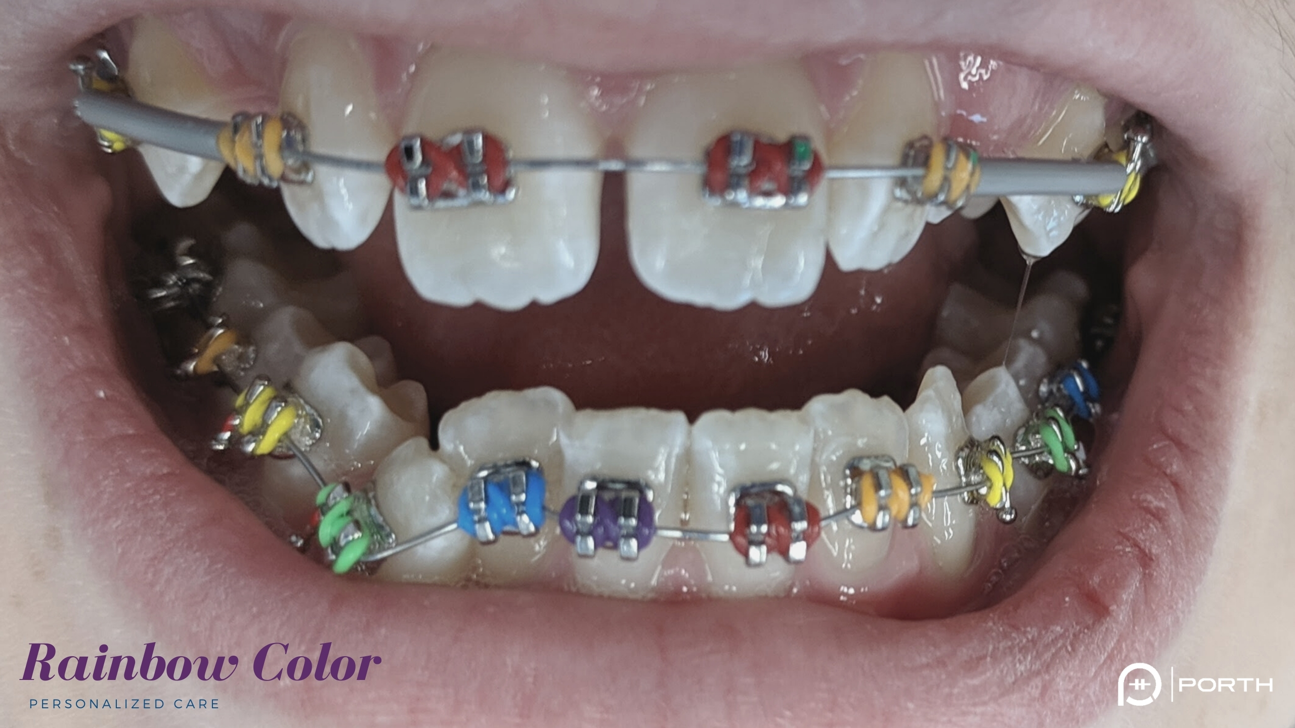 Colored Braces Modern Orthodontics Clinic