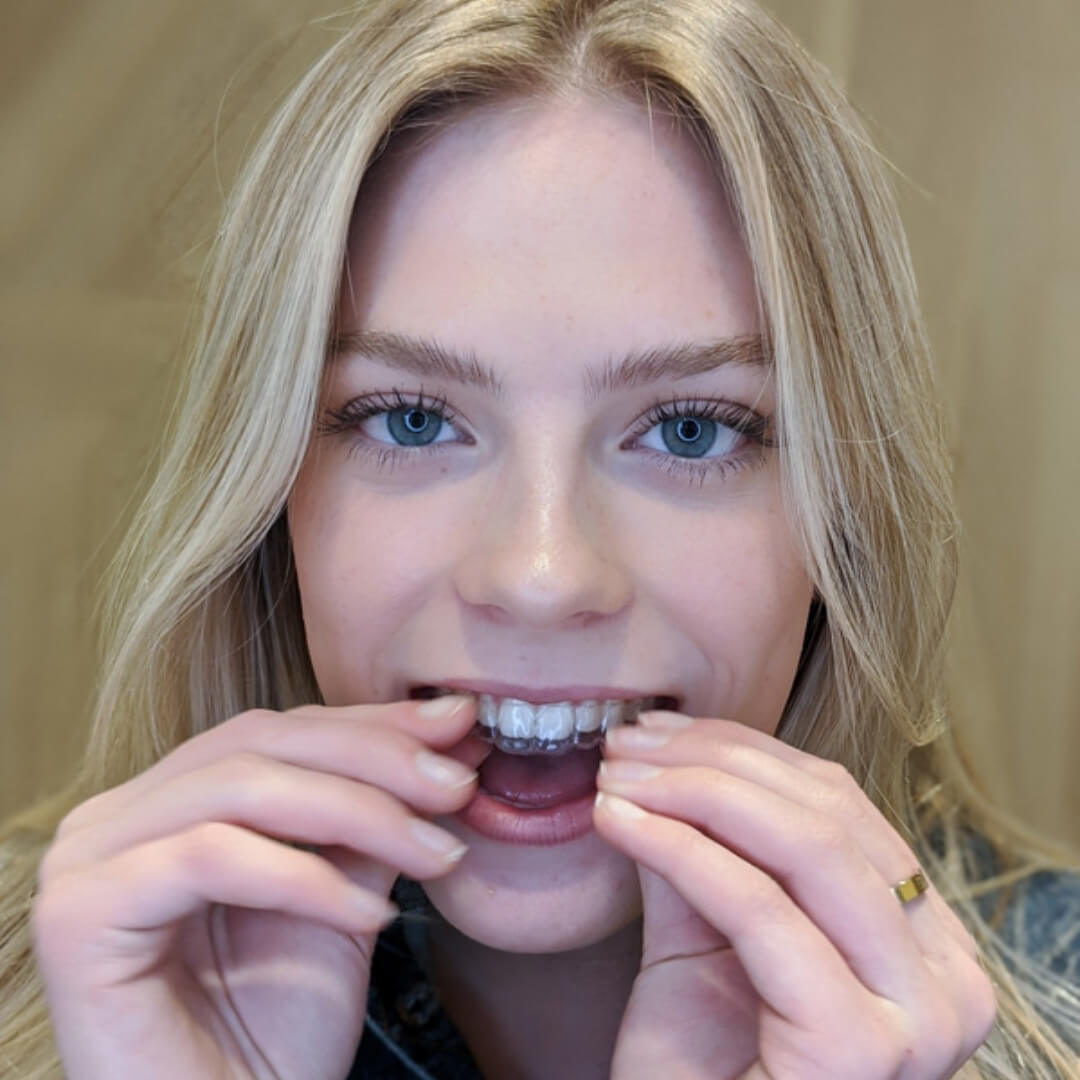 Teen clear aligners
