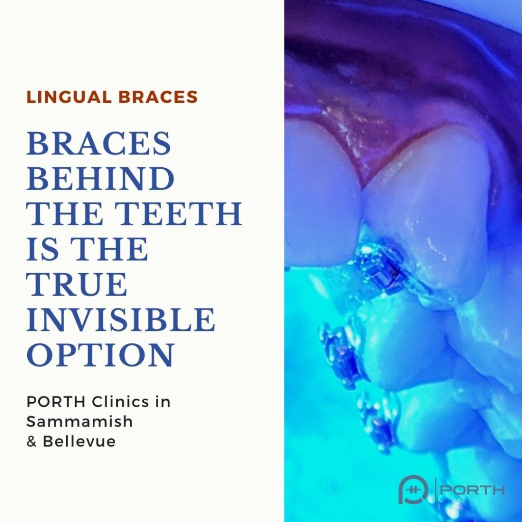 Type of lingual braces 