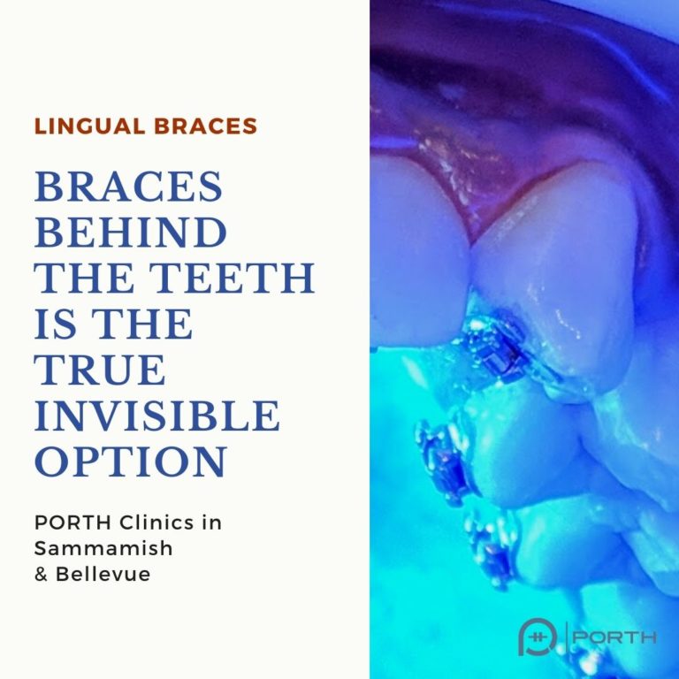 5 Main Differences Between Invisalign And Lingual Braces