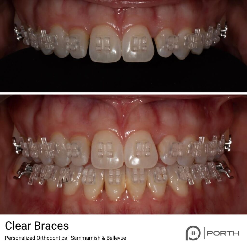 Clear ceramic brackets