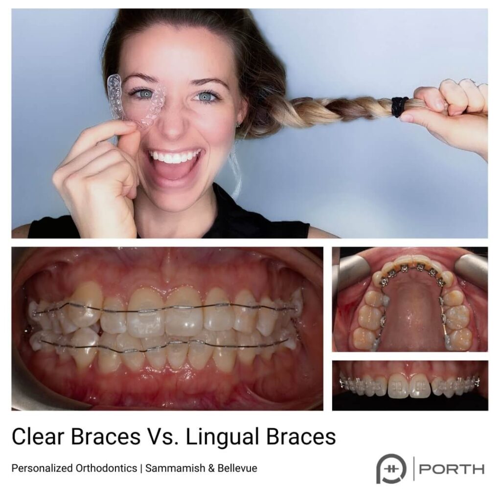 Clear braces vs clear aligners 