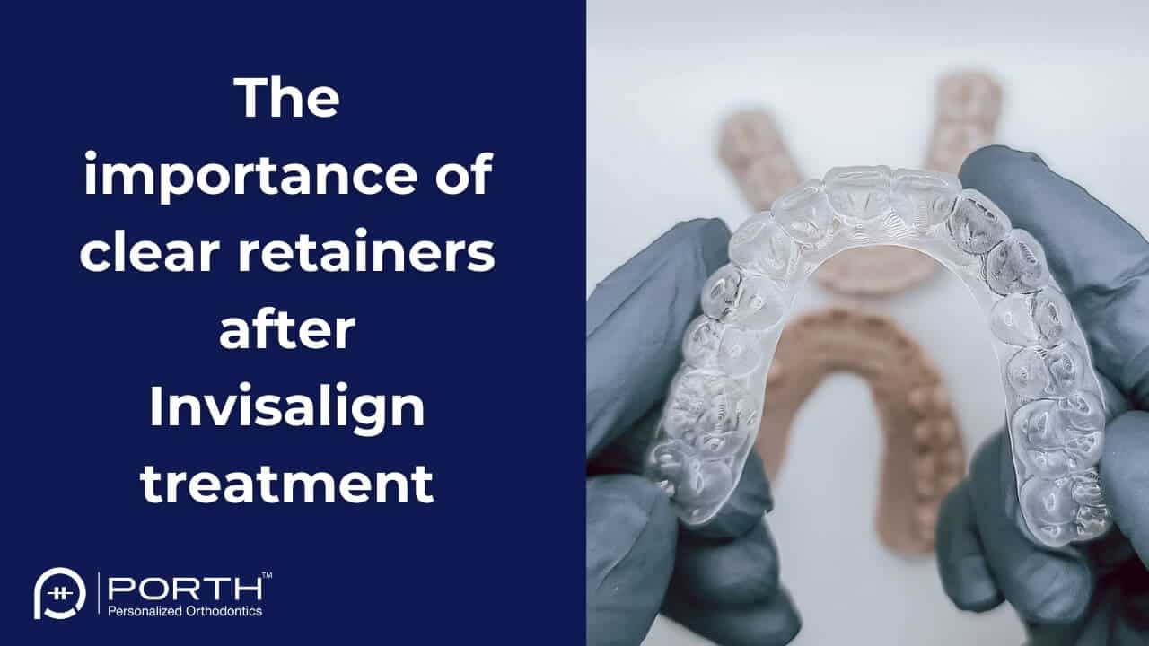 Featured image for “Clear retainers after Invisalign treatment”