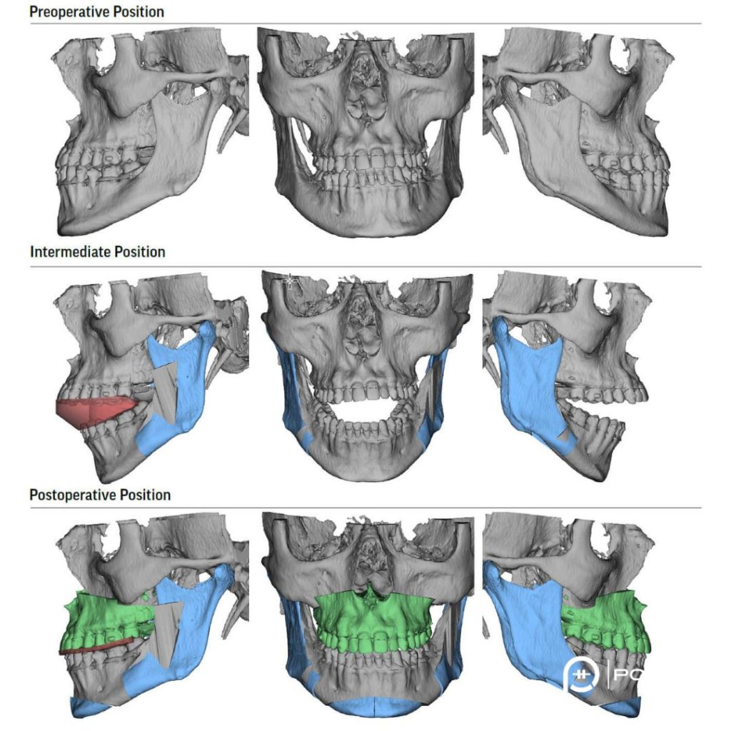 Orthognathic Surgery