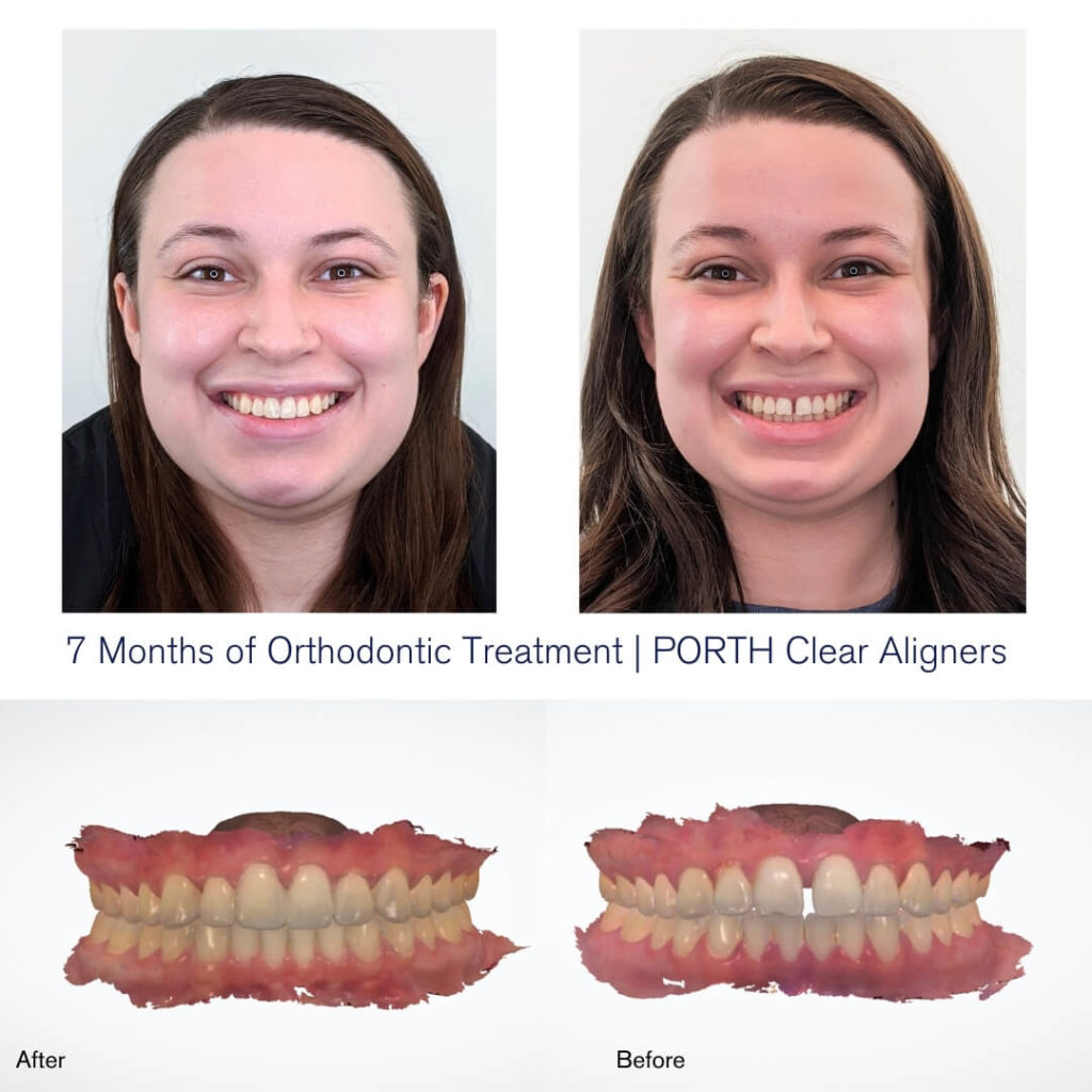 PORTH clear aligners