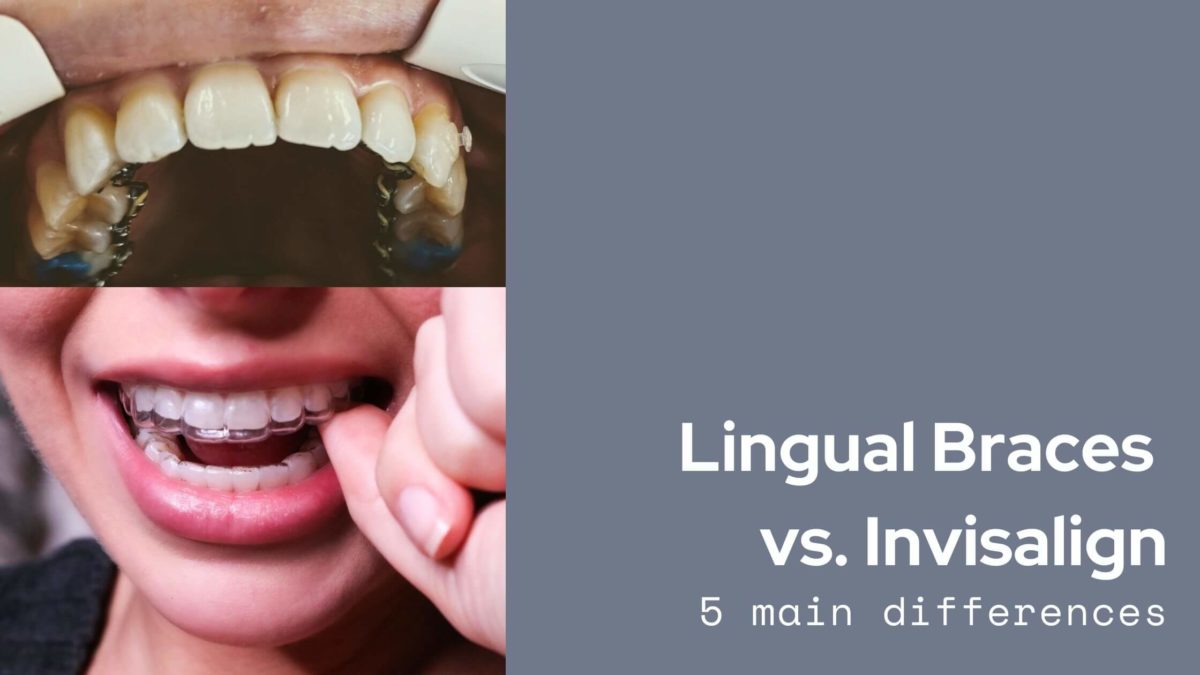5 Main Differences Between Invisalign And Lingual Braces Modern Orthodontic Clinic In Sammamish Dr Rooz Khosravi