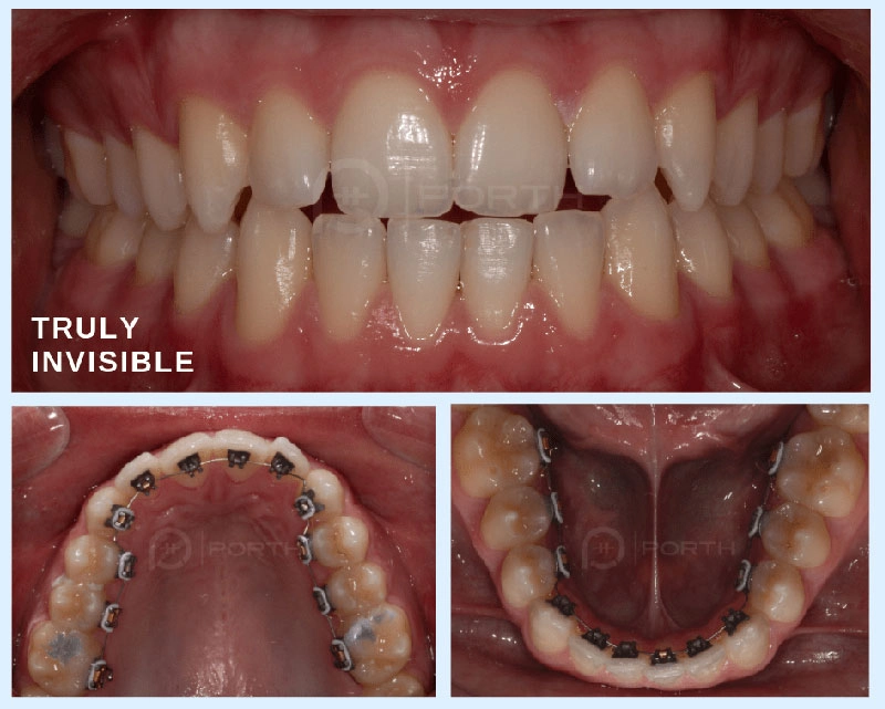 5 main differences between Invisalign and lingual braces