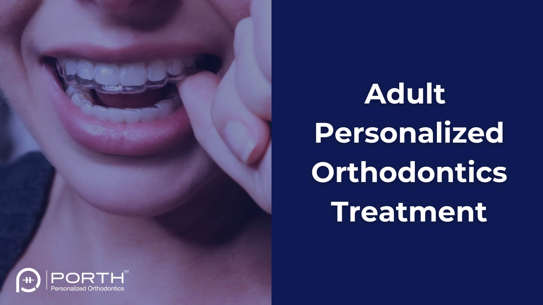 Adult Orthodontics Sammamish Issaquah