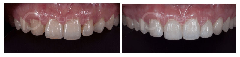 Porth-Adult-Orthodontics-Rooz-v3