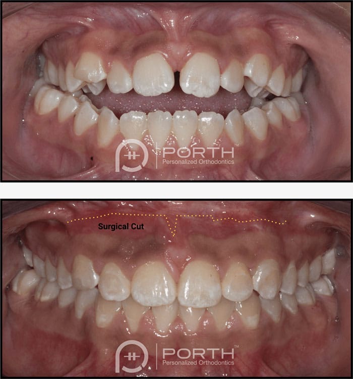 Rooz-Sammamish-Orthodontist-jaw-surgery