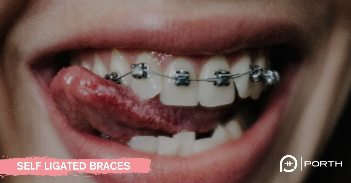 Braces