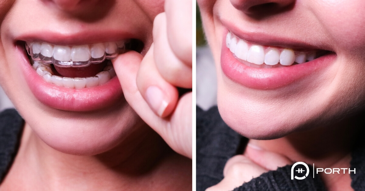 Invisalign sensitive teeth