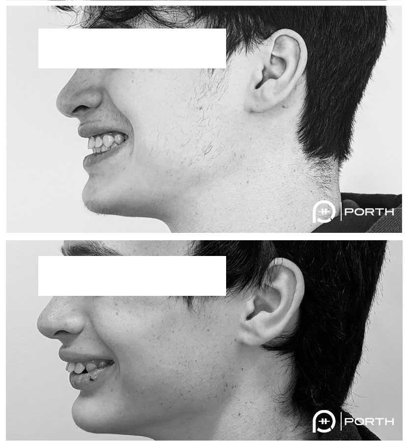 BSSO Jaw surgery