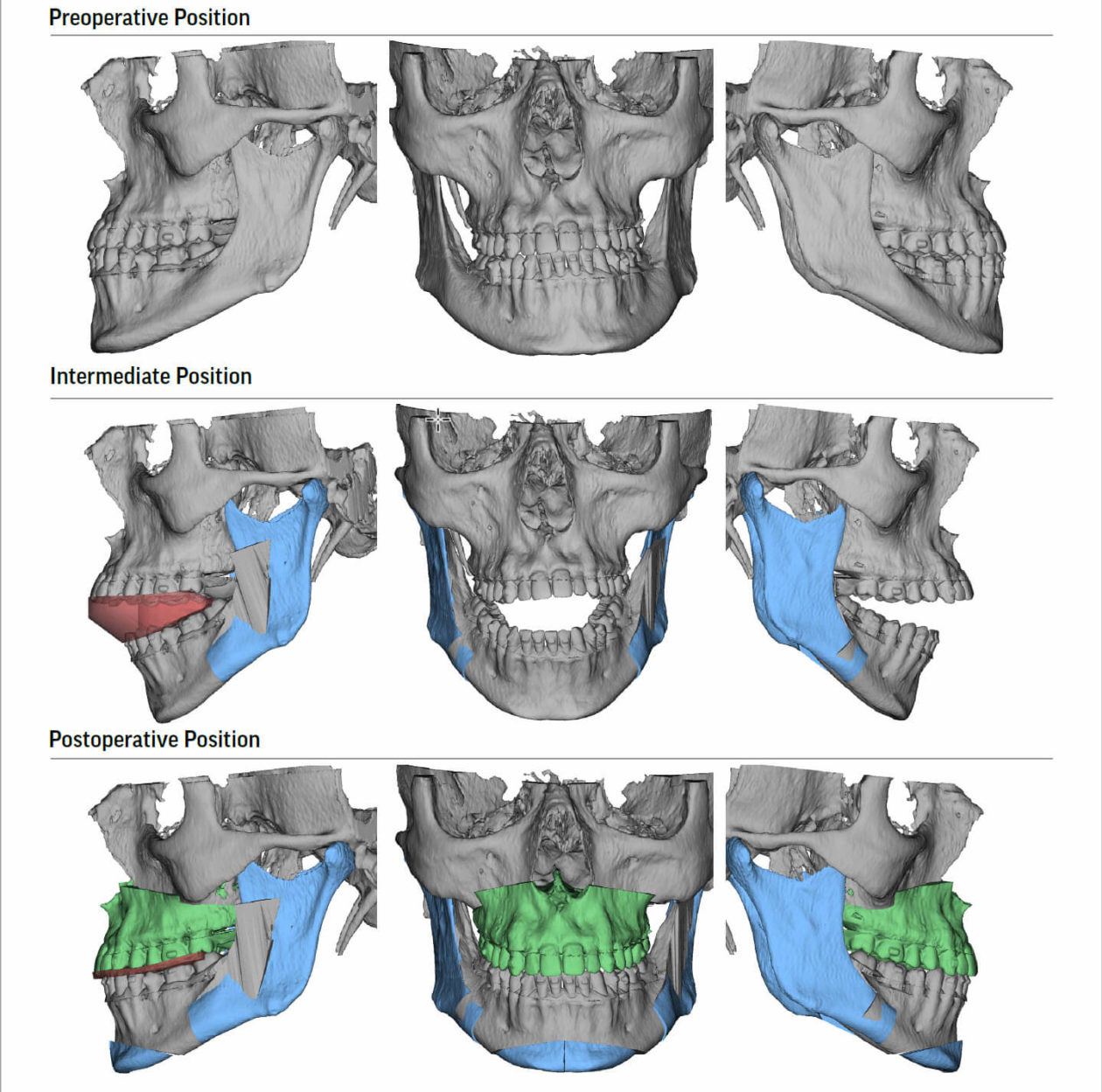 Jaw Expander for Adults - Modern Orthodontic Clinic in Sammamish & Bellevue