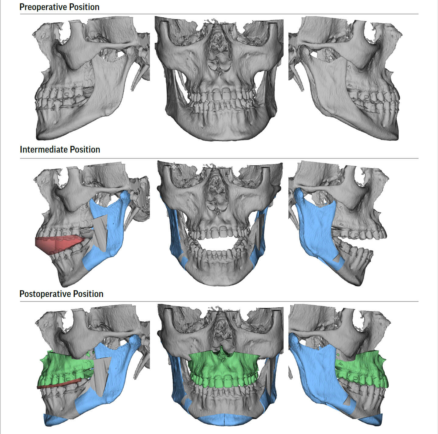 Jaw Expander for Adults - Modern Orthodontic Clinic in Sammamish u0026 Bellevue