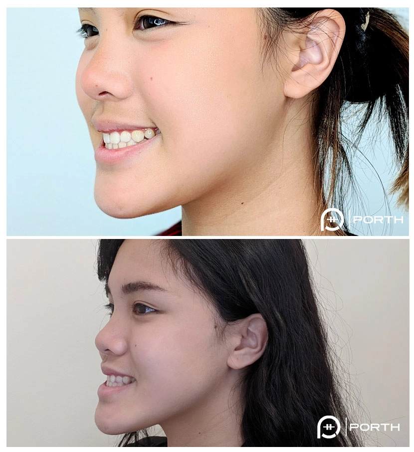 overbite correction cost