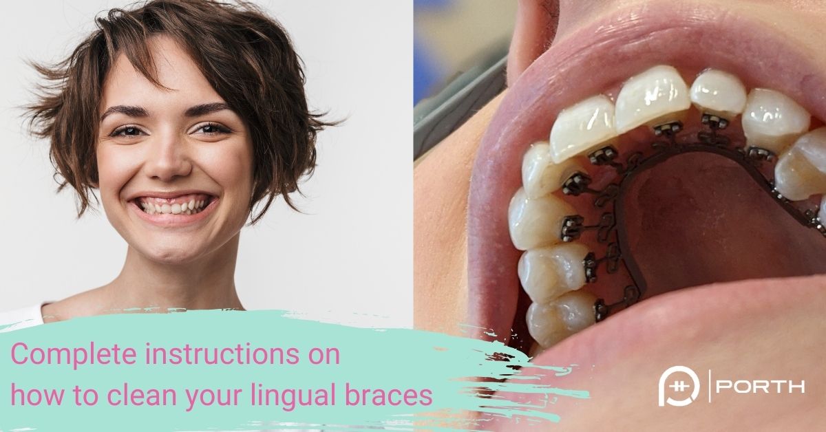 lingual braces cleaning