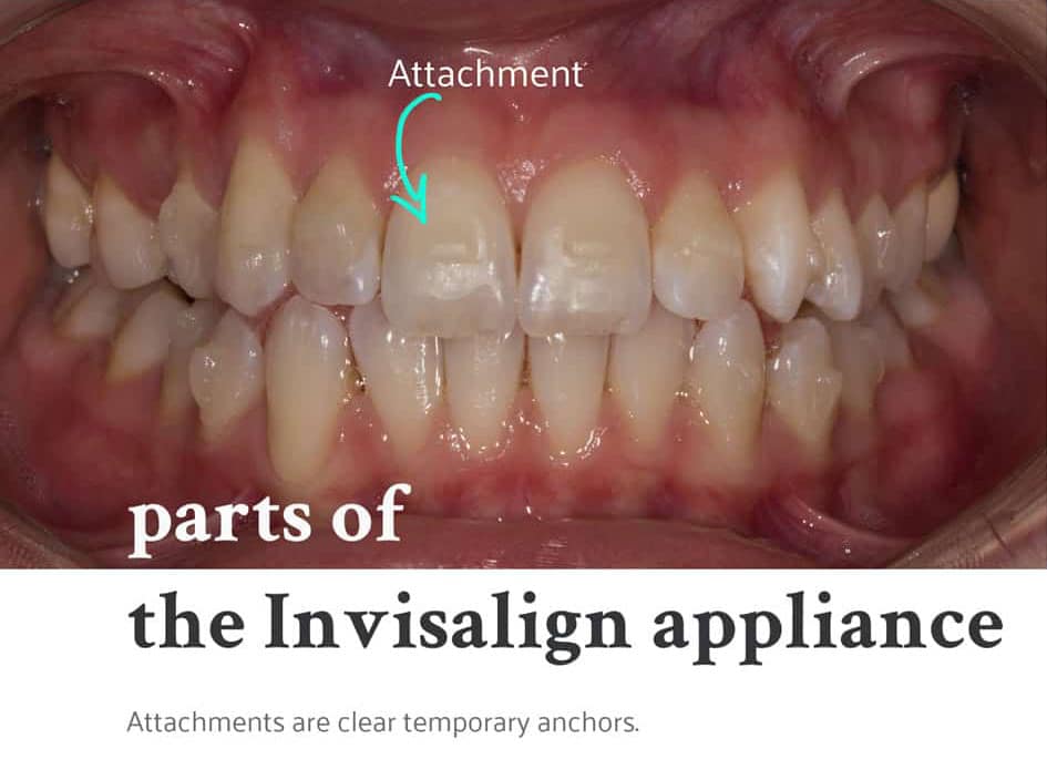 All You Need To Know About The Invisalign Appliance Dr Rooz Porth