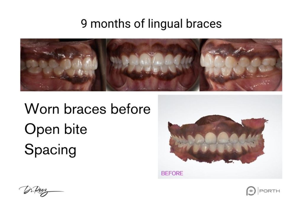 Invisible Braces  What is BRIUS lingual braces?