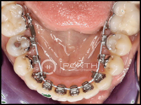 porth-Lingual-braces