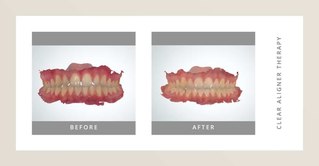 porth-clear-aligners-before-after