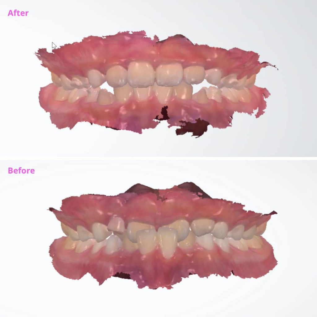 porth-invisalign-before-after