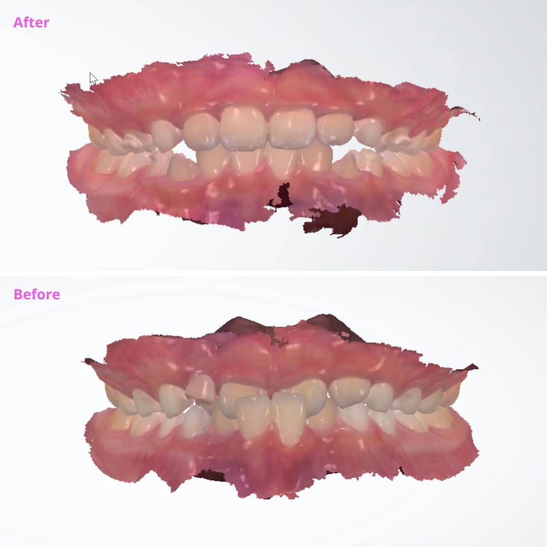 Invisalign Porth Clear Aligners Top Provider In Sammamish