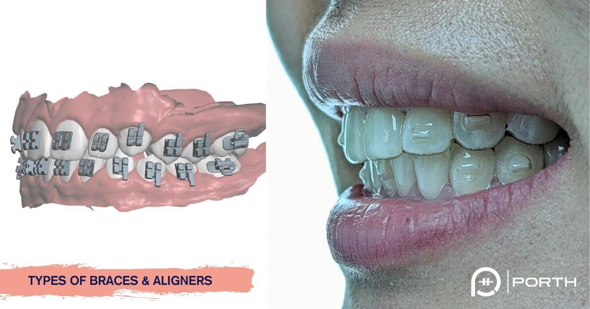 braces types